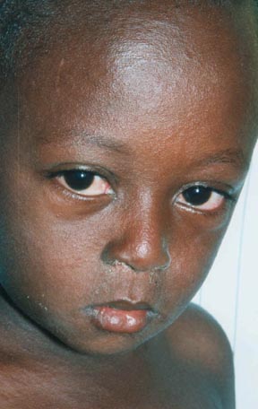 Chicken Pox Virus In Eyes