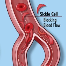 sickel cell graphic