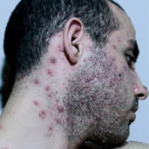 image of monkeypox